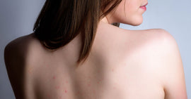 How to Treat and Prevent Back Acne Scars for Clear Skin