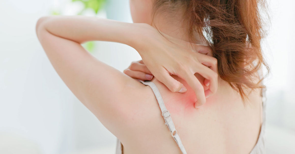 Itchy Sunburn Causes, Symptoms, and How to Get Relief Solvaderm