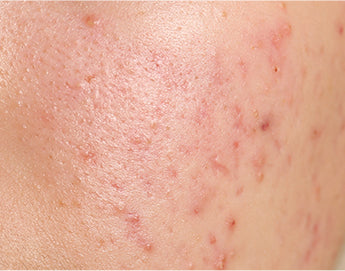 10 DIY Skincare Remedies to Shrink Pimples Fast
