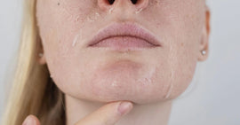 How To Get Rid of Peeling Skin: 4 Effective Steps