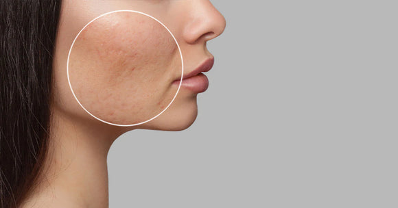 Skincare Routine For Acne Scars: Ultimate Guide