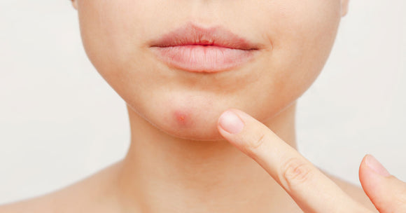Acne Under Chin - Ways to Get Rid of Chin Acne