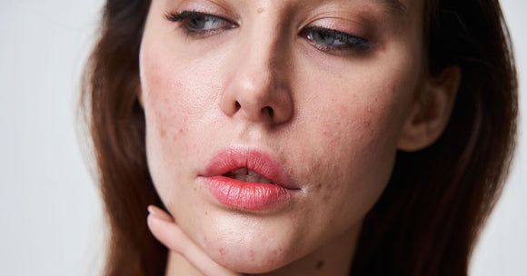 Bumpy Skin on the Face: Causes, Treatments, and Prevention
