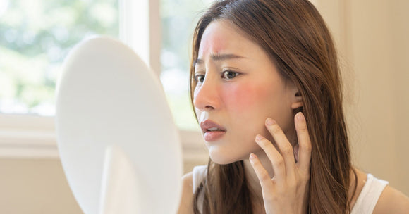 Facial Eczema: Discover the Best Tips for Managing It