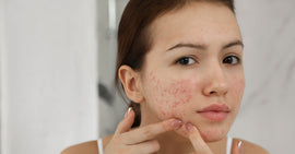 What Is Fungal Acne? Symptoms, Prevention, & Treatment