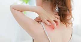 What is Itchy Sunburn and How Can You Find Relief?