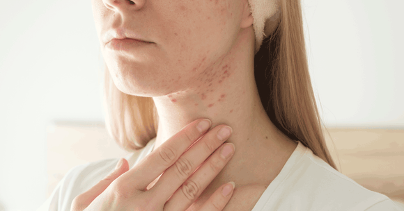Neck Acne: A Comprehensive Guide to Causes & Treatment