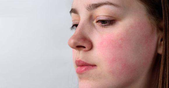 What to Know About Psoriasis on the Face