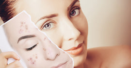 Types of Skin Blemishes: Diagnosis and Solutions