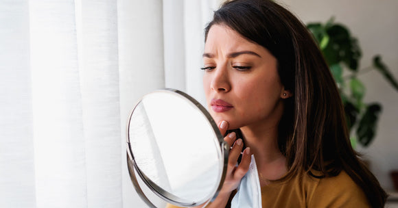 Stress Acne: Managing and Preventing Breakouts